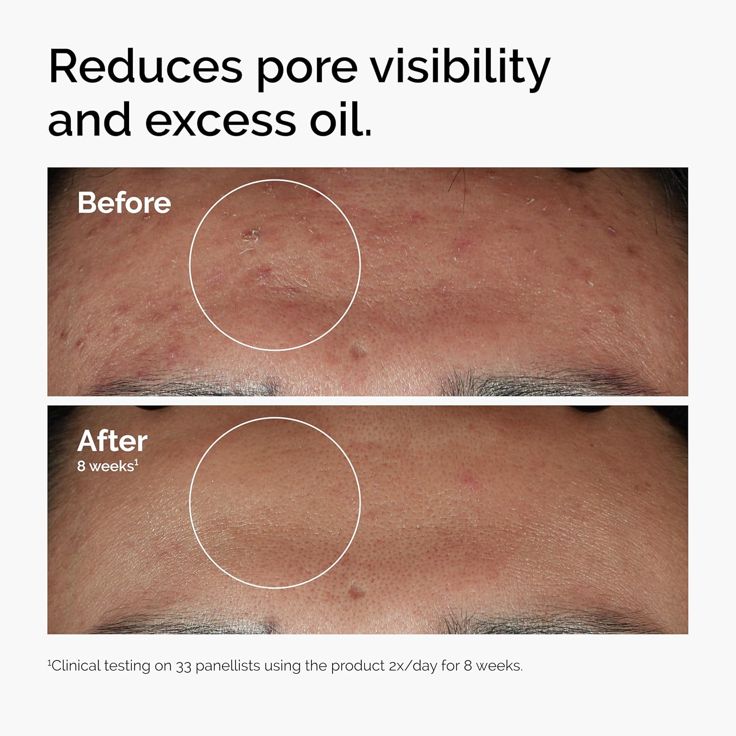 The Ordinary Niacinamide 10% + Zinc 1%, Serum Calmante para Piel Propensa a Imperfecciones, Controla el Acné y Reduce Poros, 30 ml - Imagen 7